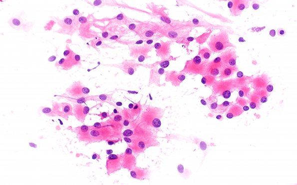 24A1 Rhabdoid meningioma (Case 24) H&E smear