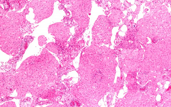 24A2 Rhabdoid meningioma (Case 24) H&E areaA 10X