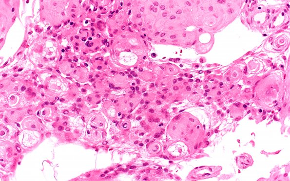 24A3 Rhabdoid meningioma (Case 24) H&E areaA 40X