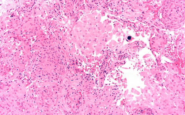 24A4 Rhabdoid meningioma (Case 24) H&E A2 20X