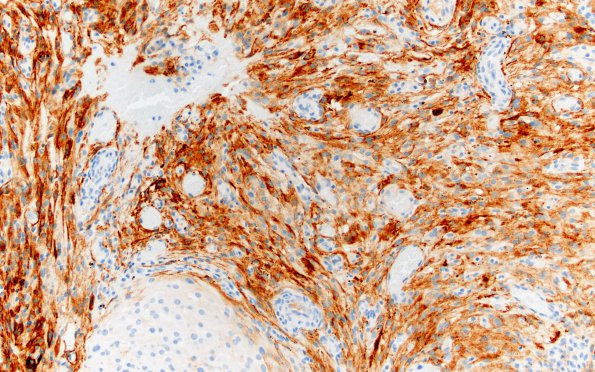 24B Rhabdoid meningioma (Case 24) EMA 20X