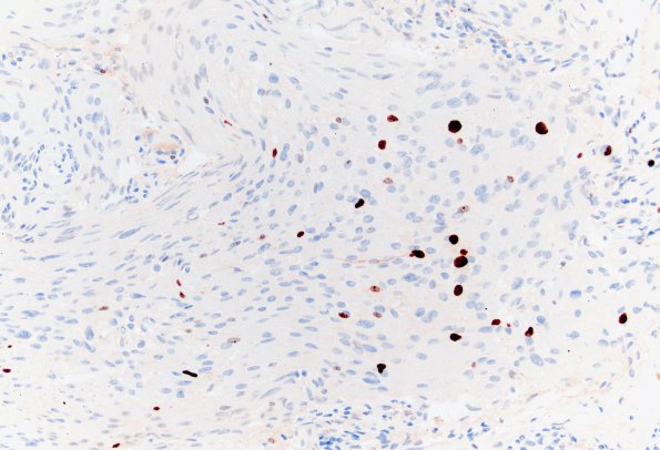 24C Rhabdoid meningioma (Case 24) Ki67 20X