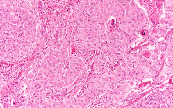 26A1 Meningioma, rhabdoid (Case 26) H&E 20X 3