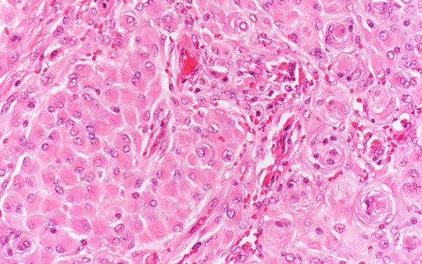 26A4 Meningioma, rhabdoid (Case 26) H&E 40X 2