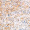 27C4 (Case 27) EMA xanthomatous cells C10 40X 2