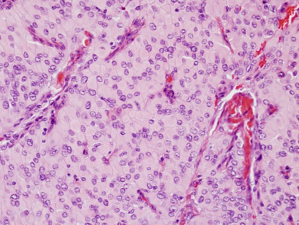 2A4 Meningioma, pap&rhab (Case 2) H&E 8.jpg