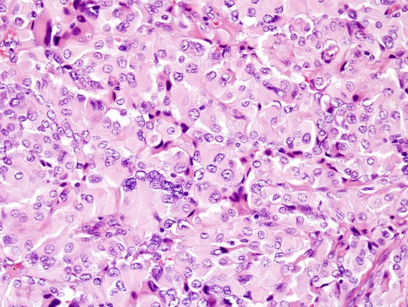 2A5 Meningioma, pap&rhab (Case 2) H&E 6.jpg