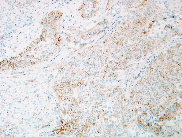 2B1 Meningioma, pap&rhab (Case 2) EMA 1