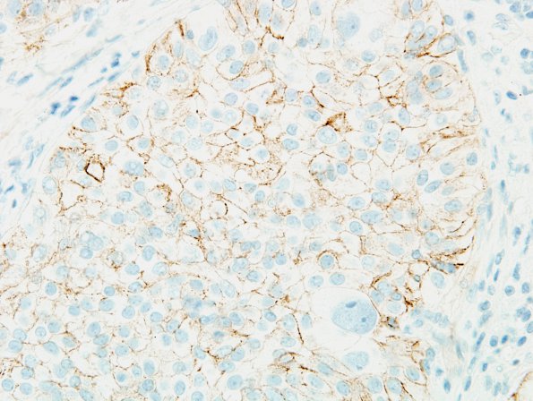 2B2 Meningioma, pap&rhab (Case 2) minimal EMA 6.jpg