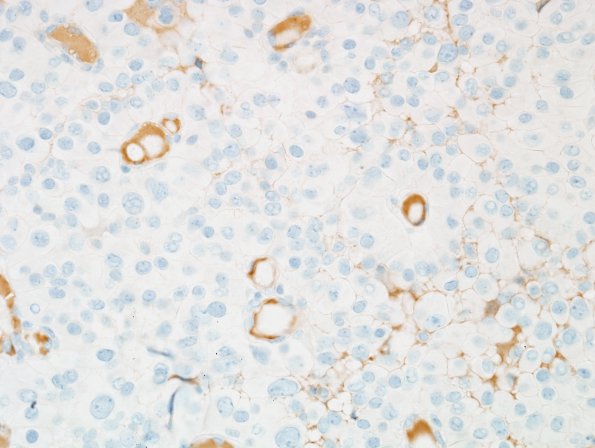 2C Meningioma, pap&rhab (Case 2) PR none 2.jpg