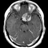 3A1 Meningioma, rhabdoid (Case 3) T1W 2 - Copy