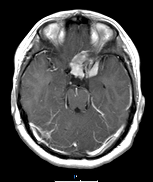 3A1 Meningioma, rhabdoid (Case 3) T1W 2 - Copy