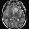 3A2 Meningioma, atypical with rhabdoid features, NF2, 12yo (Case 3) T2 2 - Copy