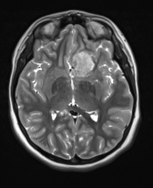 3A2 Meningioma, atypical with rhabdoid features, NF2, 12yo (Case 3) T2 2 - Copy