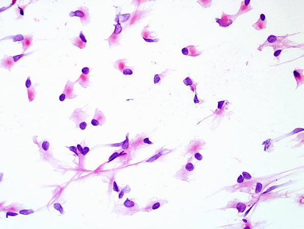 3B1 Meningioma, atypical w rhabdoid features (Case 3) H&E RP R 1 smear.jpg