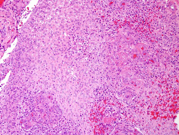 3B2 Meningioma, atypical w rhabdoid features (Case 3) H&E 2.jpg