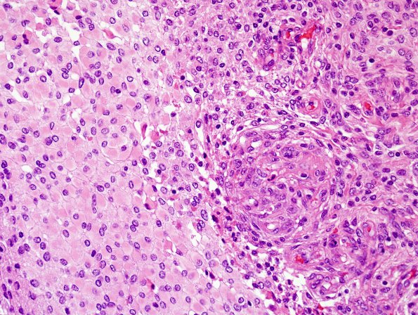 3B3 Meningioma, atypical w rhabdoid features (Case 3) H&E area A 40X.jpg