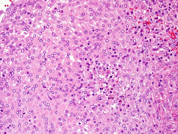 3B4 Meningioma, atypical w rhabdoid features (Case 3) H&E 3.jpg