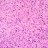 3B5 Meningioma, atypical w rhabdoid features (Case 3) H&E 1.jpg