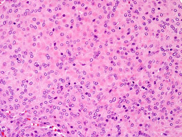 3B5 Meningioma, atypical w rhabdoid features (Case 3) H&E 1.jpg