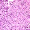 3B6 Meningioma, atypical w rhabdoid features (Case 3) H&E 5.jpg