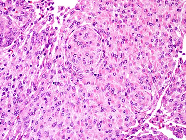 3B6 Meningioma, atypical w rhabdoid features (Case 3) H&E 5.jpg