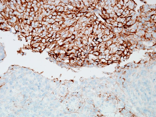 3C Meningioma, atypical w rhabdoid features (Case 3) EMA 2.jpg