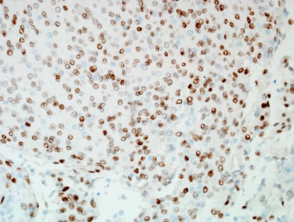 3D Meningioma, atypical w rhabdoid features (Case 3) WHO II PR 1.jpg