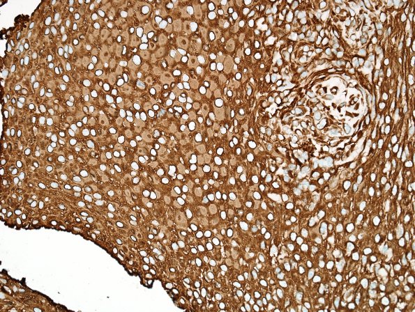 3E Meningioma, atypical w rhabdoid features (Case 3) VIM area A 40X 2.jpg