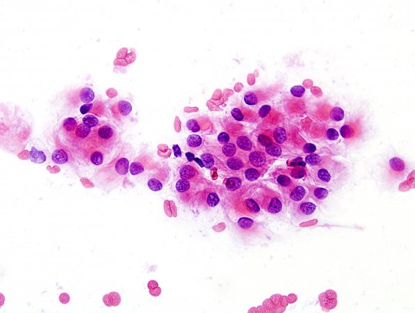 4A1 Meningioma, focal rhabdoid (Case 4) H&E smear 1.jpg