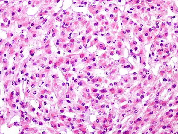 4A3 Meningioma, focal rhabdoid (Case 4) H&E 4.jpg