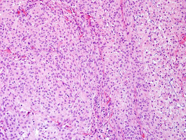 4A4 Meningioma, focal rhabdoid (Case 4) H&E 2.jpg