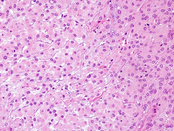 4A5 Meningioma, focal rhabdoid (Case 4) H&E 1 RES Focal R.jpg