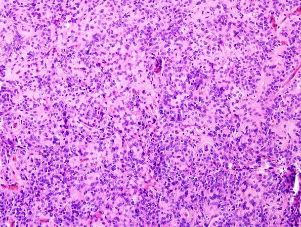 5A1 Meningioma, atypical w rhabd (Case 5) H&E 9.jpg