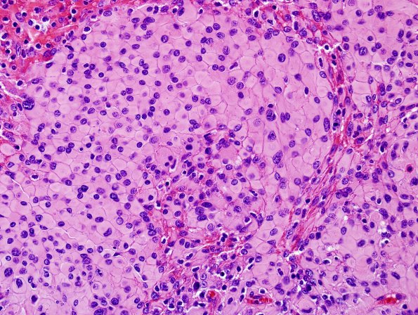 5A2 Meningioma, atypical w rhabdoid features & Increased proliferation (Case 5) H&E 3.jpg