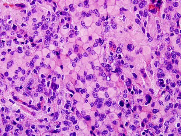 5A3 Meningioma, atypical w rhabdoid features & Increased proliferation (Case 5) H&E 4.jpg