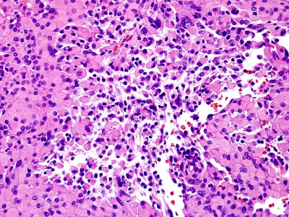 5A45 Meningioma, atypical rhabdoid (Case 5) H&E 2 RES Extensive R