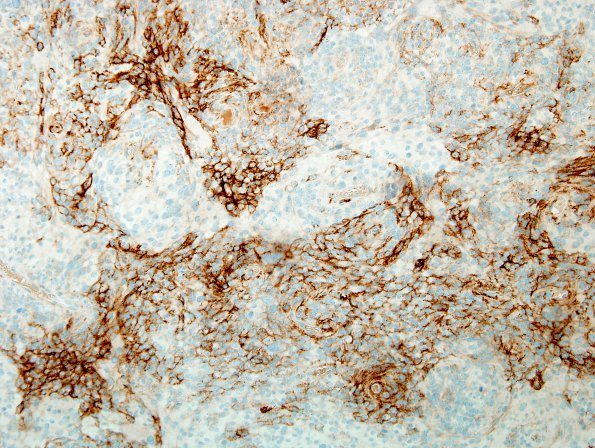 5B1 Meningioma, atypical w rhabd (Case 5) EMA 3.jpg