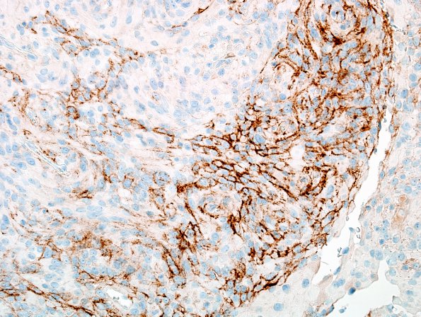 5B2 Meningioma, atypical w rhabd (Case 5) EMA 2.jpg