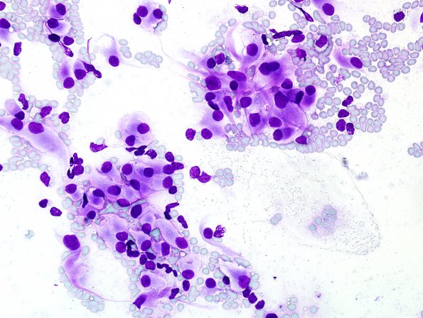 5F Meningioma, atypical w rhabdoid (Case 5) Wright 1.jpg