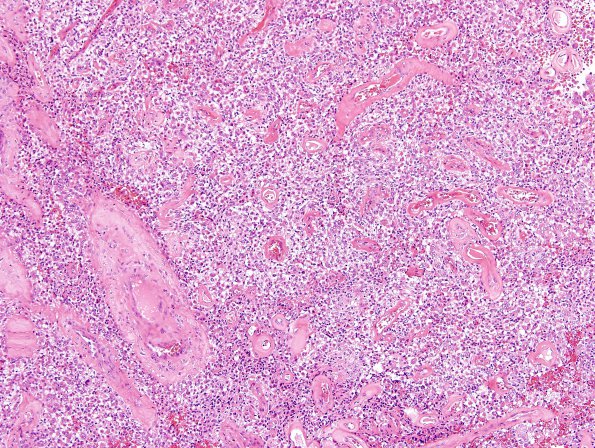 6A1 Meningioma, rhabdoid (2 yo, Case 6) H&E 11 Rhab AP.jpg