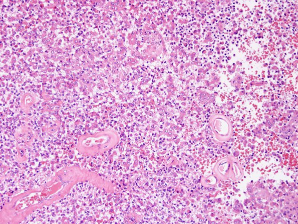 6A2 Meningioma, rhabdoid (2 yo, Case 6) H&E 8.jpg