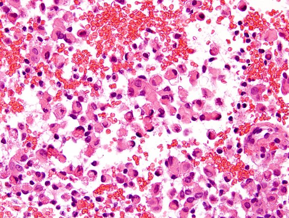 6A3 Meningioma, rhabdoid (2 yo, Case 6) H&E 4.jpg