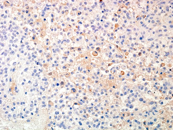 6B Meningioma, rhabdoid (2 yo, Case 6) EMA.jpg