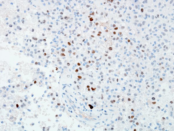 6C Meningioma, rhabdoid (2 yo, Case 6) PR 1.jpg