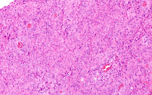 7A1 Meningioma, rhabdoid SP RadioRx (Case 7) H&E 9