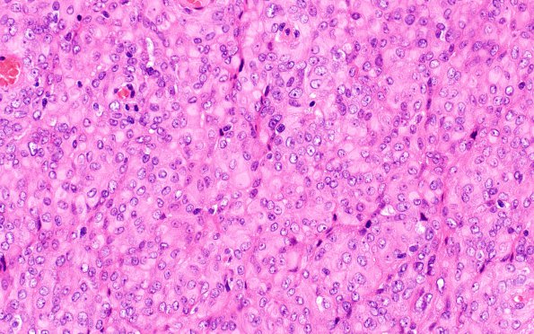 7A2 Meningioma, rhabdoid SP RadioRx (Case 7) H&E 10