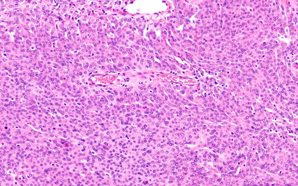 7A3 Meningioma, rhabdoid SP RadioRx (Case 7) H&E 14