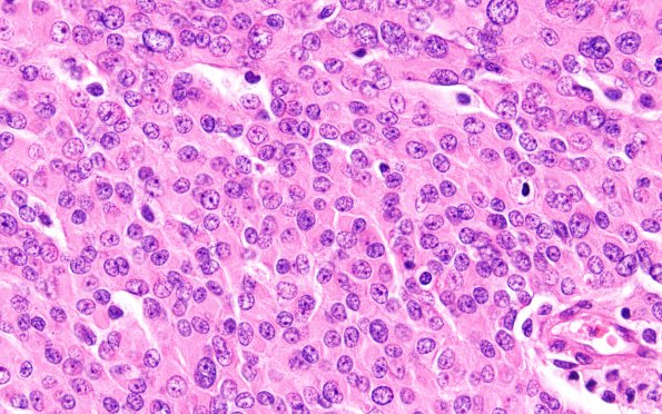 7A4 Meningioma, rhabdoid SP RadioRx (Case 7) H&E 15