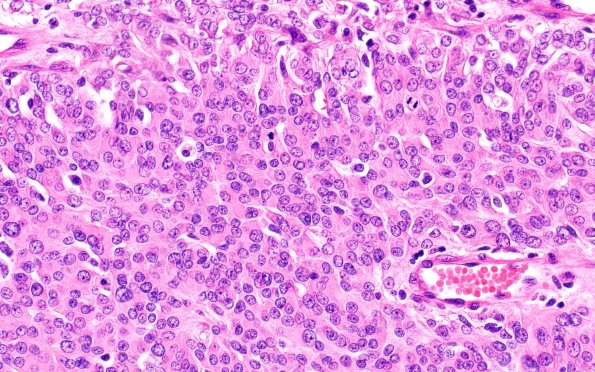 7A5 Meningioma, rhabdoid SP RadioRx (Case 7) H&E 13